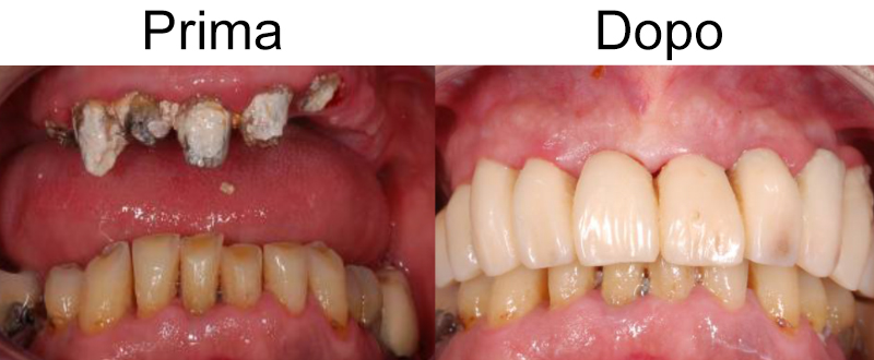 Dentista Genova, Studio Dentistico Sinagra Genova, Implantologia, Impianti, Cure dentali, Denti, Otturazioni, Paradontologia, Mal di denti